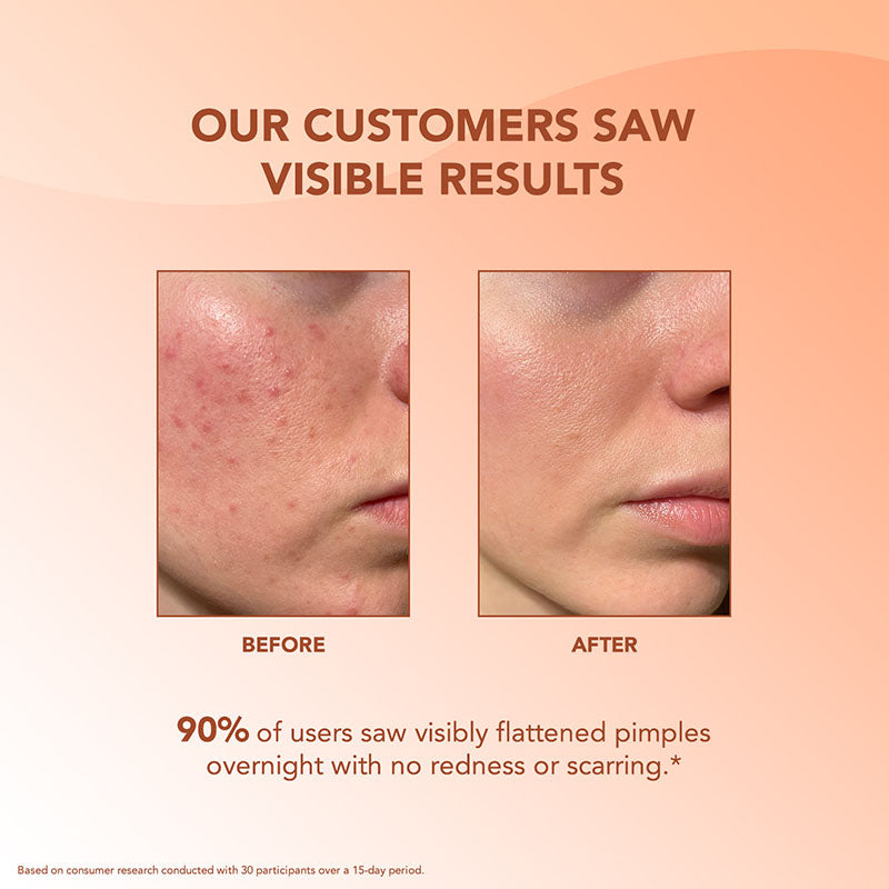 Acne Pimple Patch - 36pcs