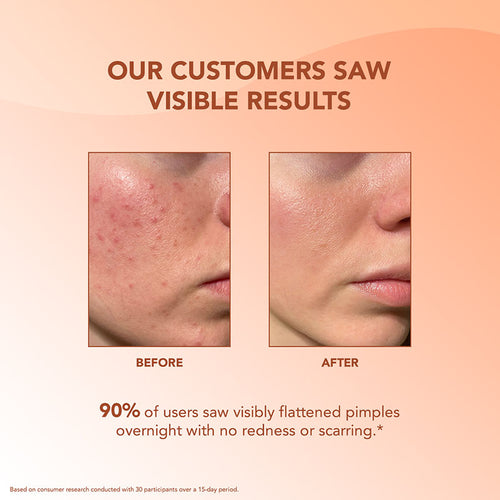 Acne Pimple Patch - 36pcs